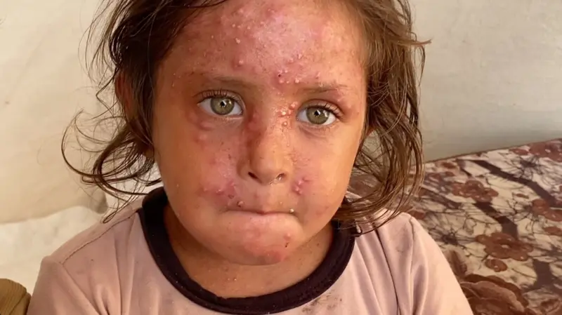 الحساسية تتفشى في غزة وسط تكدس المخيمات ونقص الدواء والماء